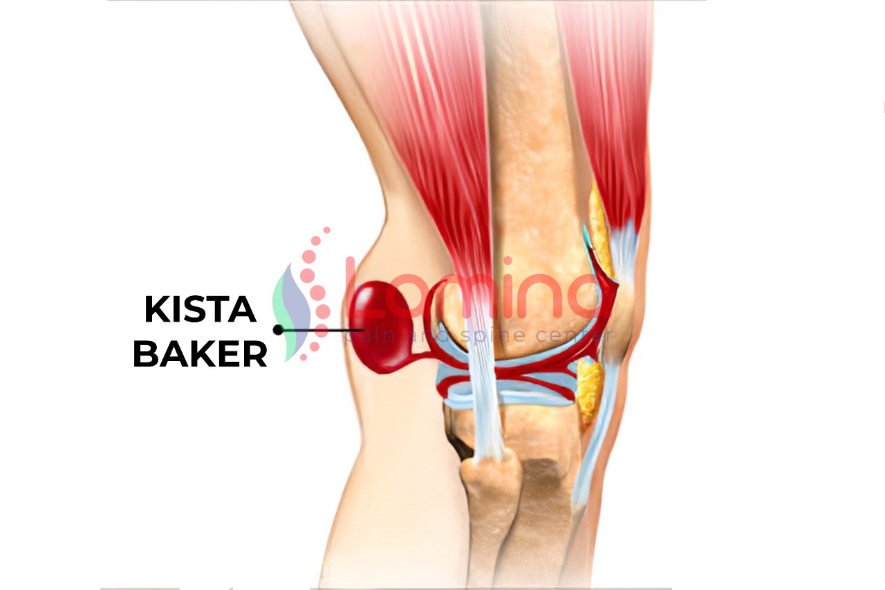 Benjolan di Belakang Lutut Atau Kista Baker » Klinik Patella