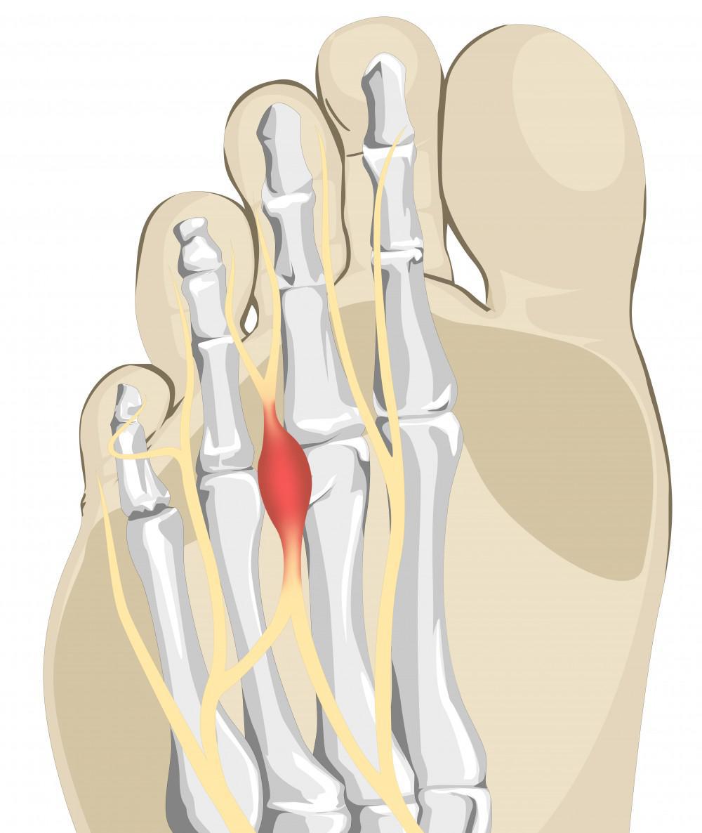 neuroma Morton menyebabkan nyeri jari kaki