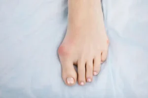 bunion