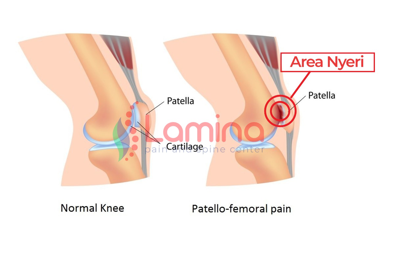 sindrom-nyeri-tempurung-lutut