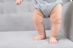 kaki bayi bengkok
