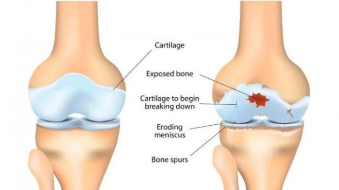 gejala radang sendi lutut