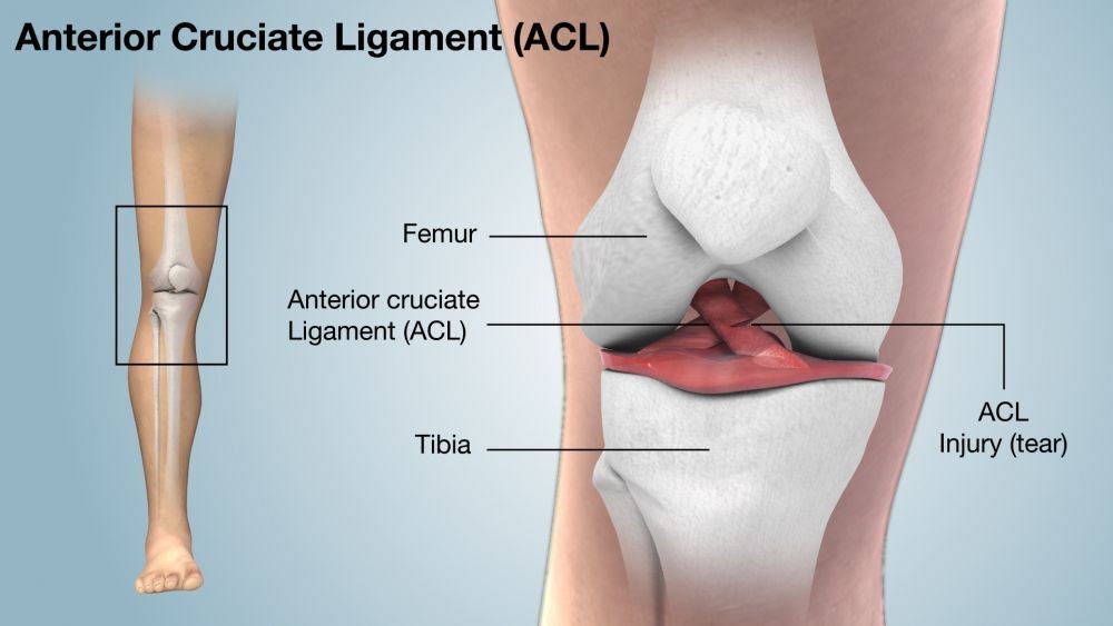 Cedera Ligamen Lutut Anterior - Patella