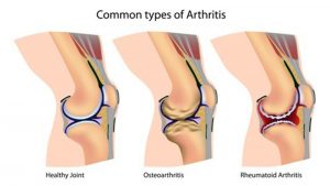 Lutut Nyeri Saat Naik Tangga Osteoarthritis - Patella