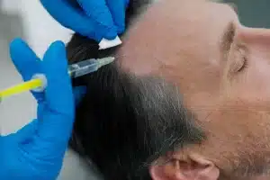 Solusi Tepat Rambut Rontok dengan Terapi PRP - Patella