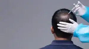 Mengatasi Masalah Kebotakan dengan PRP - Patella