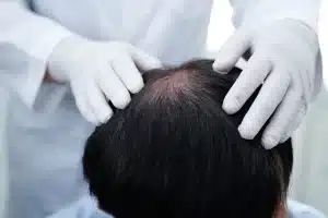 Cara Mengatasi Kebotakan Dini di Usia Muda - Patella