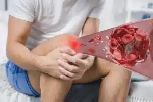 hemarthrosis