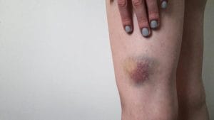 hematoma subkutan