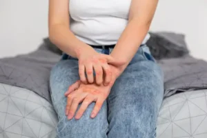 radang sendi psoriasis